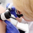melanoma szűrés