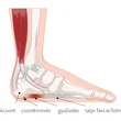 Talpi bőnyegyulladás (plantar fasciitis)