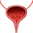 Hólyagfájdalom szindróma (interstitialis cystitis)