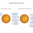 egészséges retina, dibéteszes retinopátia