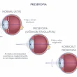 Presbyopia (öregszeműség)