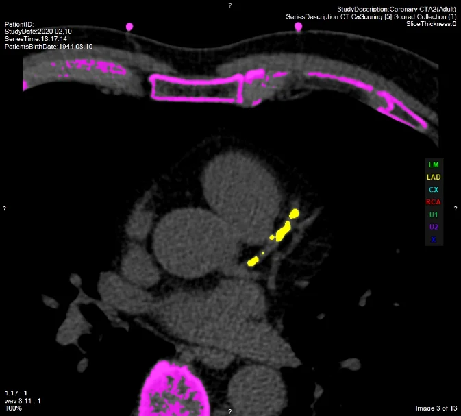 Detection of atherosclerosis affecting coronary arteries by coronary CT examination.