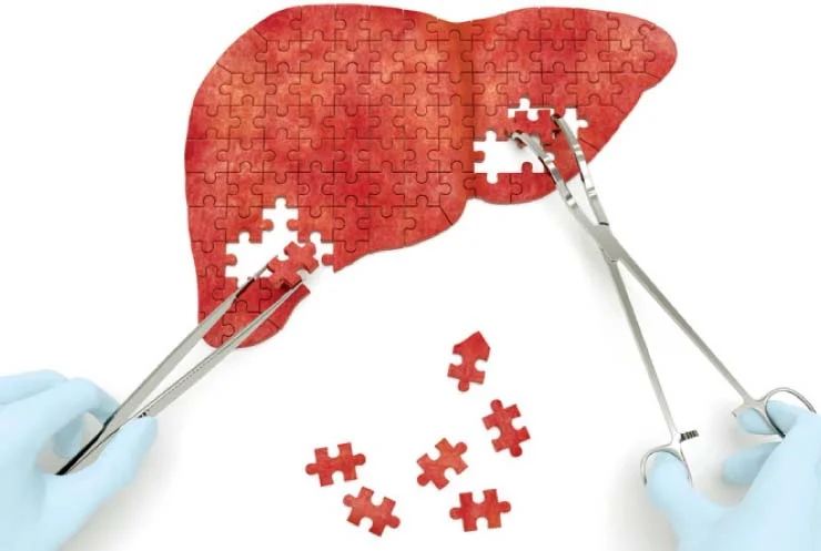 hepatitis