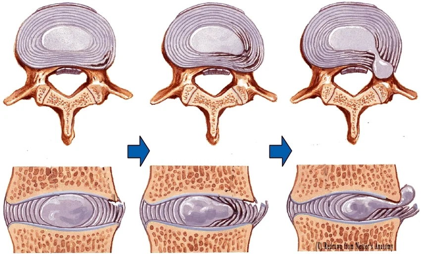 hernia_folyamat