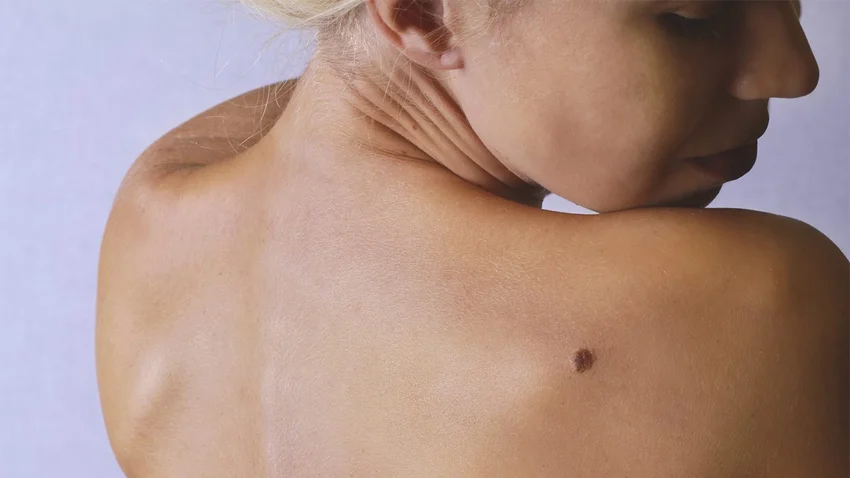 melanoma