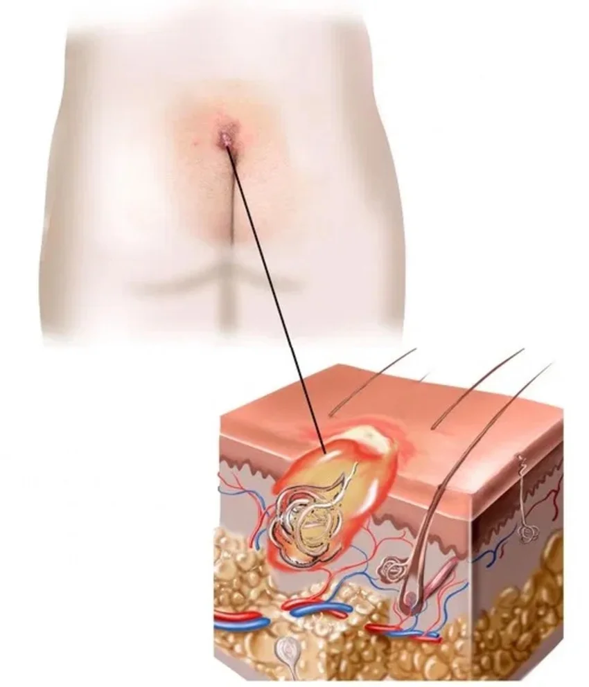 Illustration of dermoid / pilonidal cyst.