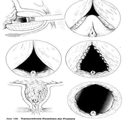 A prostata transurethralis resectioja