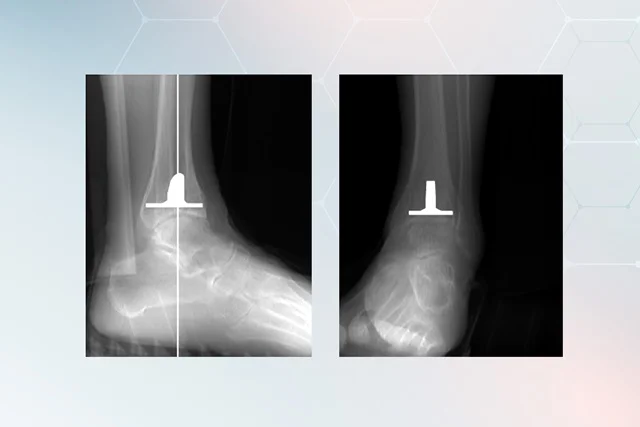 A 3D tervezés alapján sípcsonti komponens várható helyzete röntgenképen