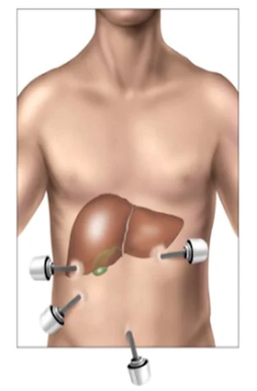 Insertion of the trocar surgically.