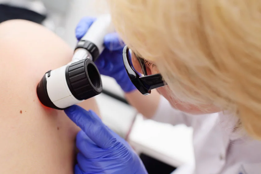 melanoma szűrés