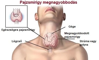Pajzsmirigy megnagyobbodás