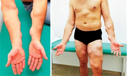 Lipoma