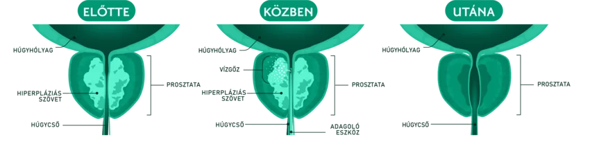Vízgőzterápia