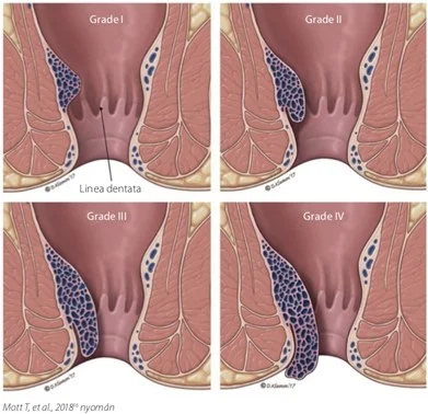 Chronic varicose veins