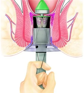 Coronary artery surgery