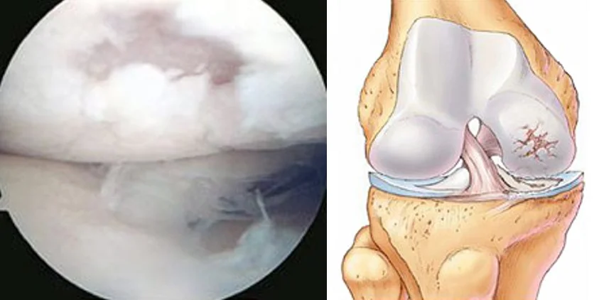 Damage to the cartilage surface