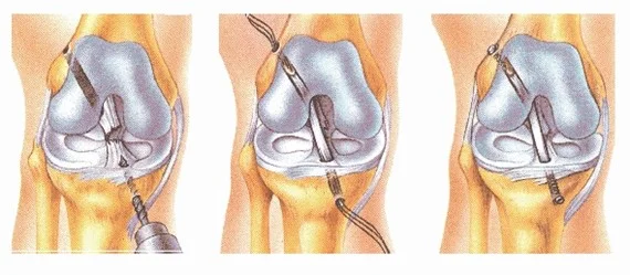 Cruciate ligament surgery