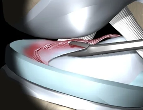 Cartilage ring removal