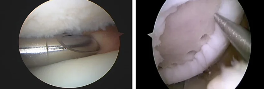 Knee joint cleaning