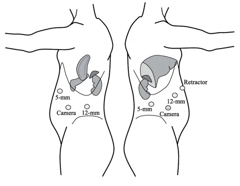 Adrenal removal by laparoscopy