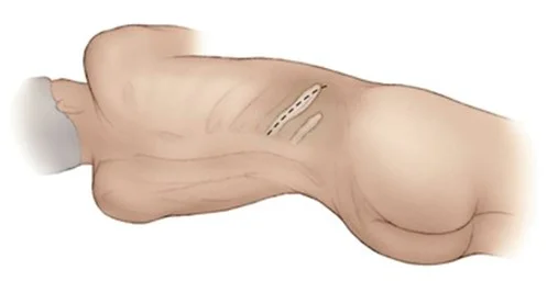 Adrenal removal by laparoscopy