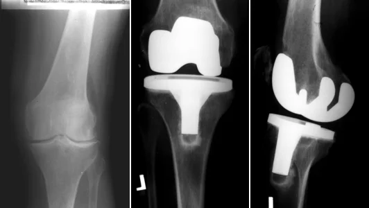 Knee joint waiting for a prosthesis and with the implanted prosthesis