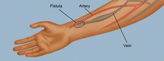 Cimino fistula készítése
