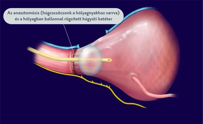 Laparoszkópos prosztateltávolítás