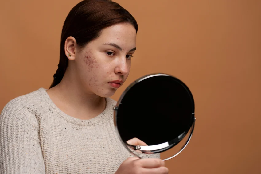Rosacea - Budai Egészségközpont