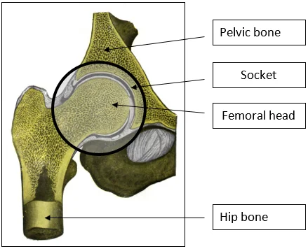 Hip replacement surgery - Buda Health Center