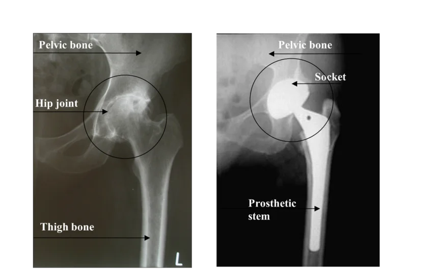 Hip replacement surgery - Buda Health Center