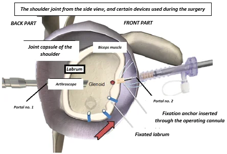 The shoulder joint and the arthroscopic portals from side view