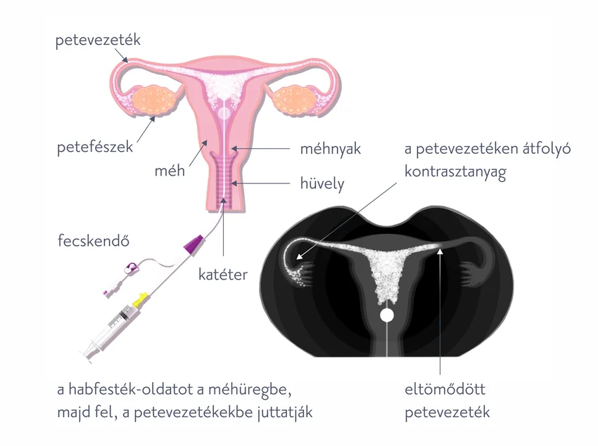 HyCoSy - ultrahangos petevezeték átjárhatósági vizsgálat