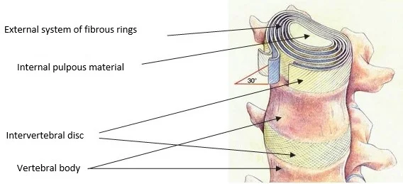 Intervertebral disc herniation surgery