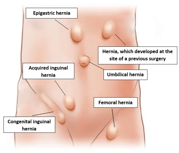 Hernia types