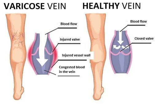 Vein surgery