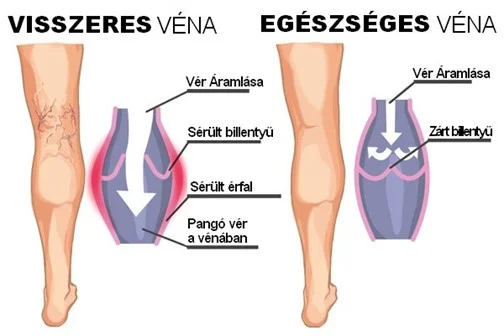 Visszérműtét