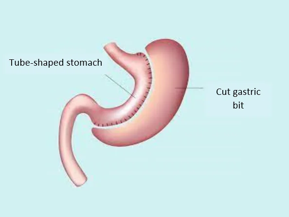 Tube-shaped-stomach - Weight loss surgery