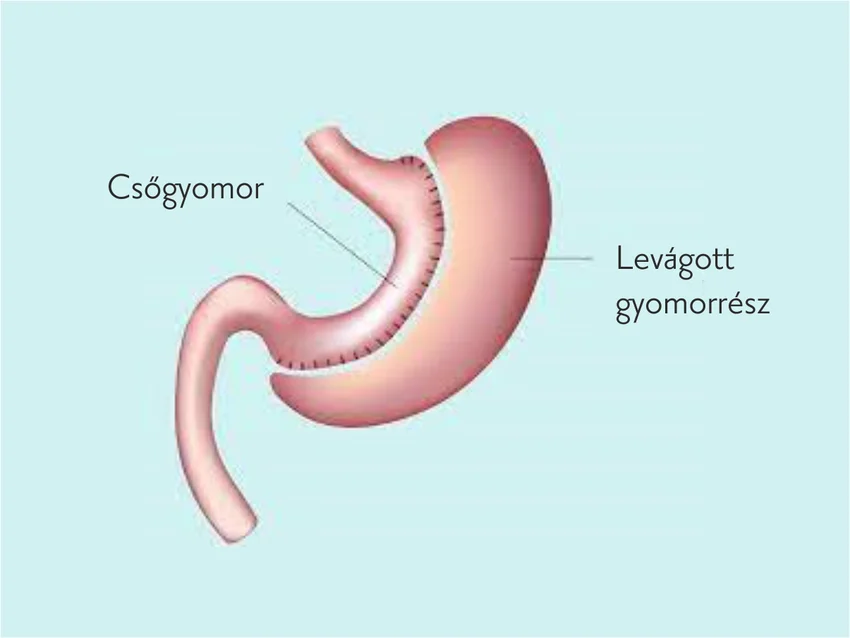 Csőgyomor - Testsúlycsökkentő műtét