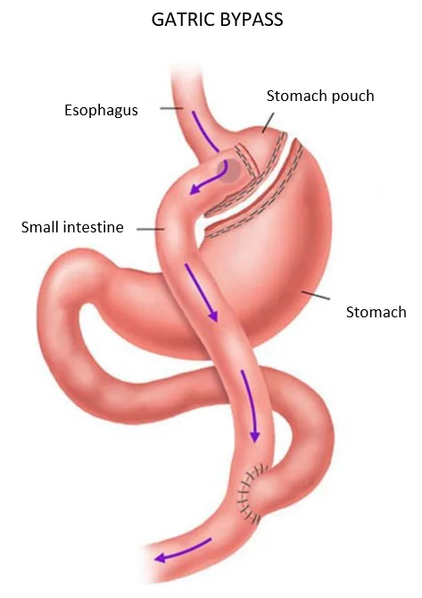 Gatric bypass - Weight loss surgery