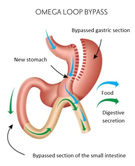 Omega loop bypass - Weight loss surgery