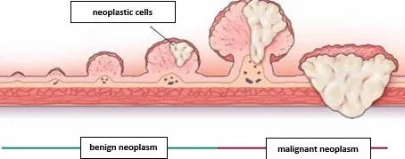 Rectal polyp surgery