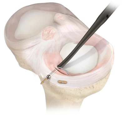 Meniscus varrat