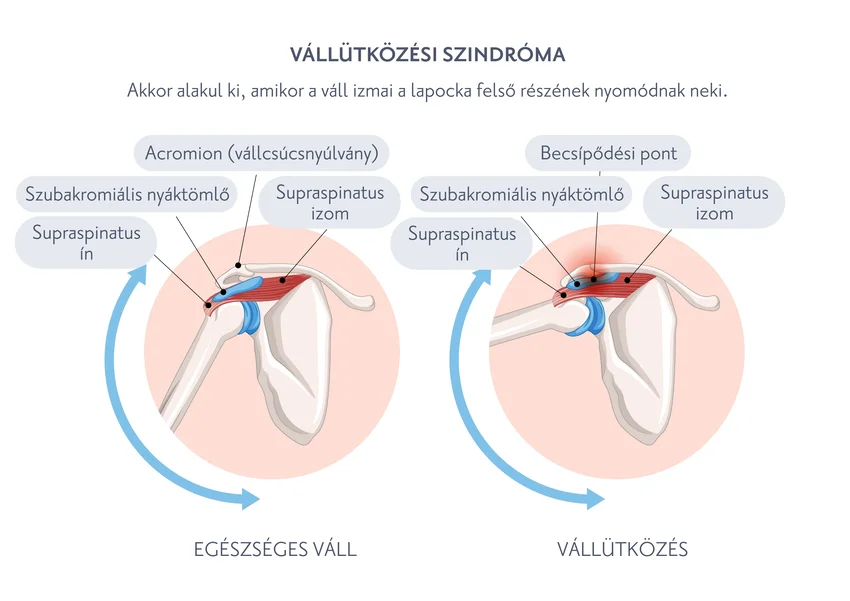 Vállütközési szindróma (impingement szindróma)