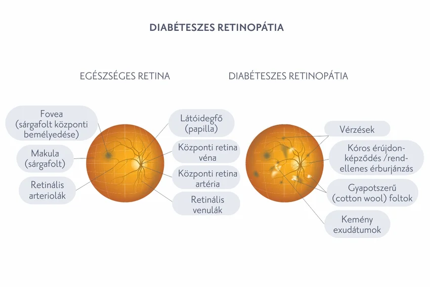 egészséges retina, dibéteszes retinopátia