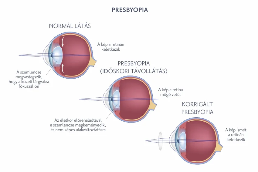 Presbyopia (öregszeműség)