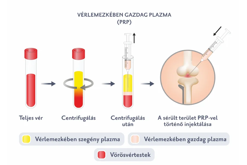 PRP terápia folyamat