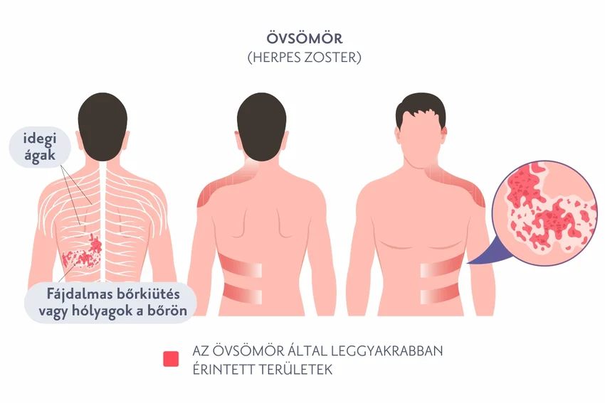 Övsömör (herpes zoster)