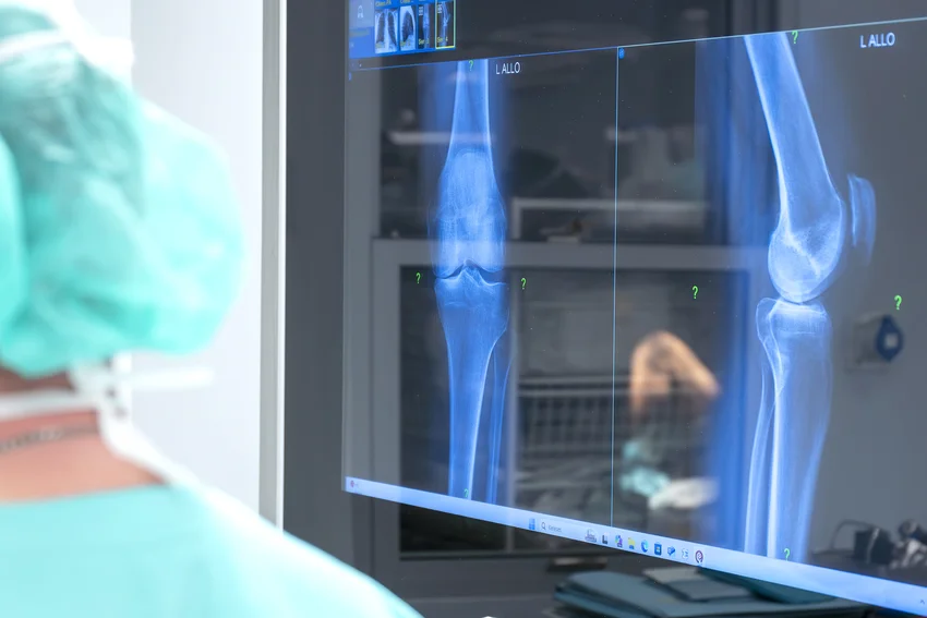 Új robotasszisztált térdműtét hozhat áttörést a részleges porckopással élők kezelésében