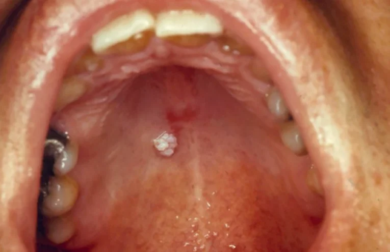 Szájüreg, garat vagy gége beningus tumor eltávolítása